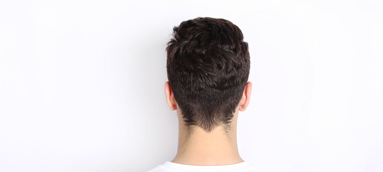 Hair Transplantation